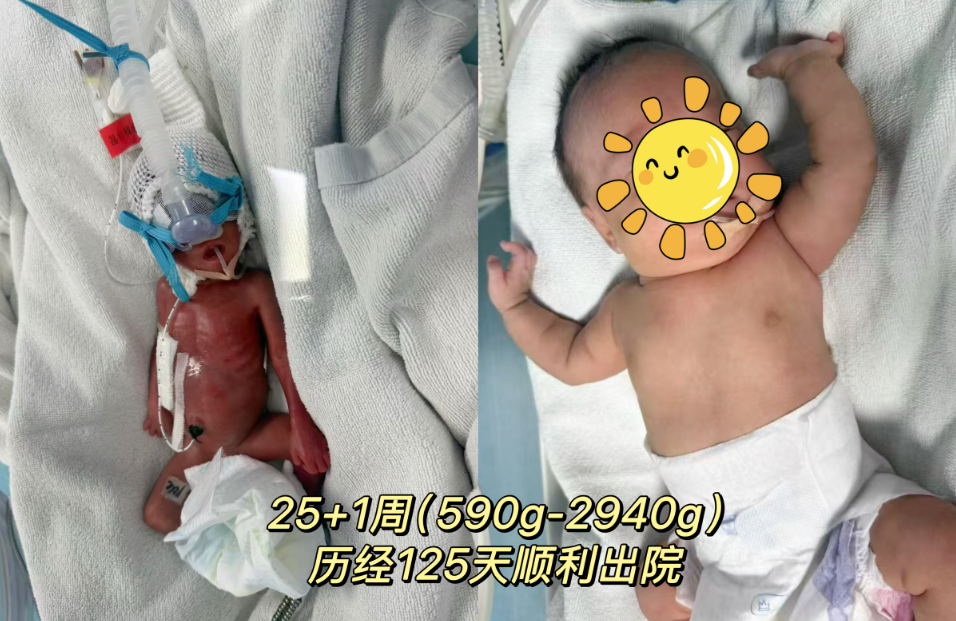 生命奇跡再刷新！懷化市婦幼保健院成功救治 25 周 出生體重僅590g的“掌心寶寶”
